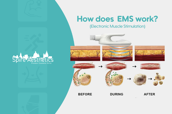 EMS treatment for post pregnancy weight loss treatment Witney