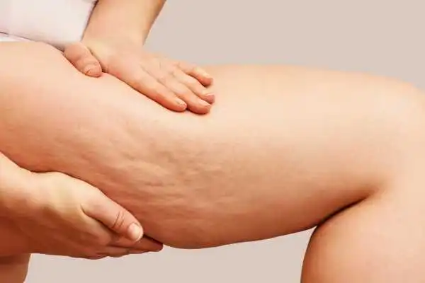 Image of woman showing leg with cellulite Witney
