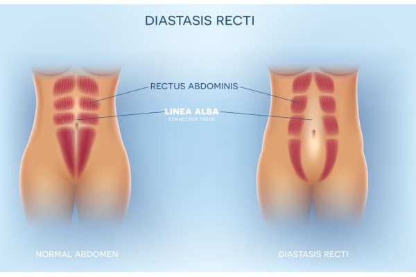 What Non-Surgical Options Are Available for Diastasis Recti Witney?