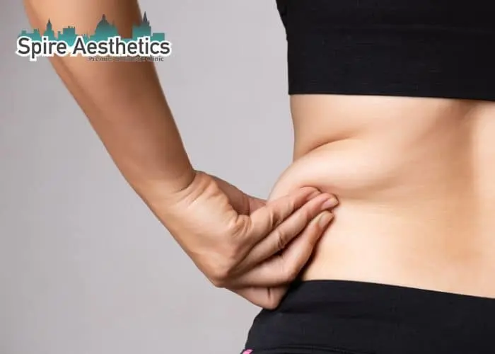 Image of woman pinching fat on their hips Witney. Fat Freezing treatment