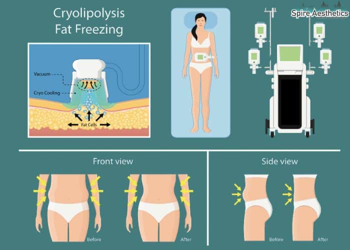 Image of diet and fat freezing combined for best results for Spire Aesthetics Witney