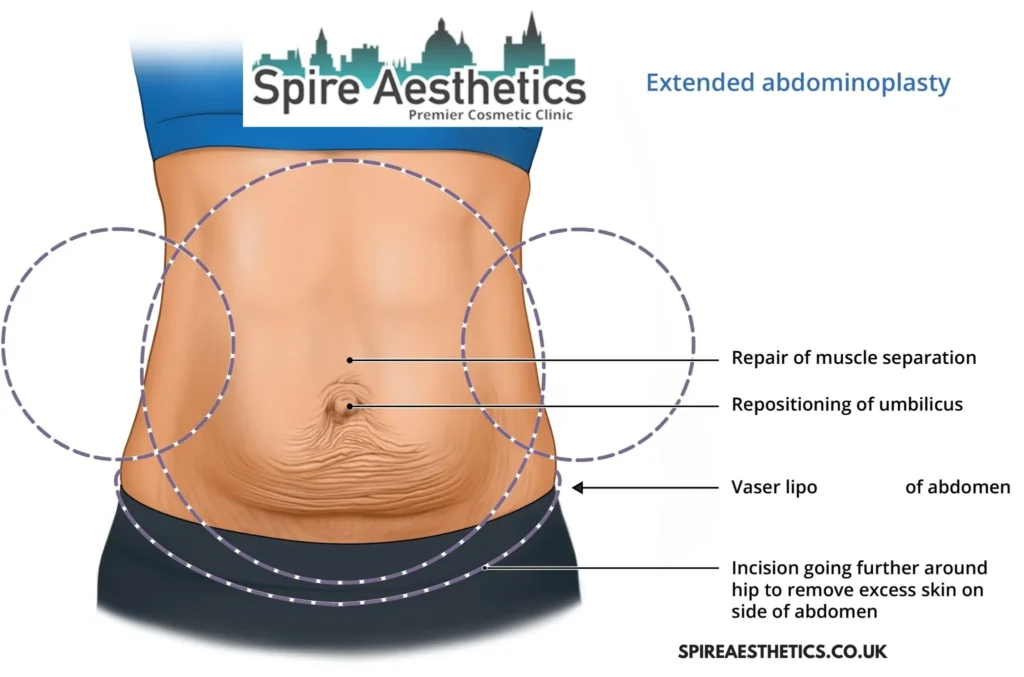 Understanding Loose Skin After Gastric Band Witney Surgery and HIFU Treatment