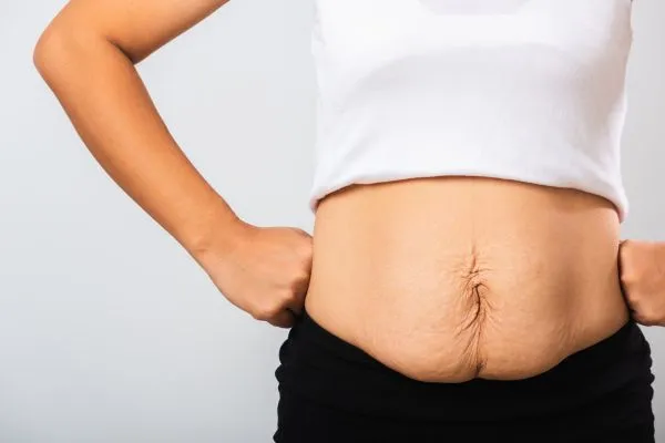 Image of a woman's stomach after weight loss with sagging skin following a gastric band Witney