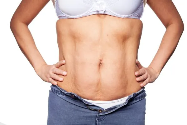 sagging skin on woman's stomach after weight loss injections Witney
