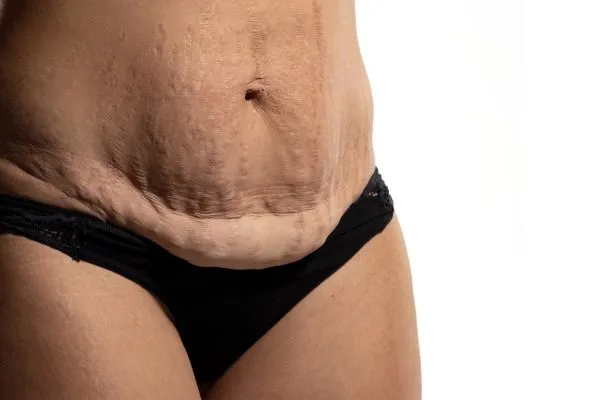Image of womans stomach after weight loss injections Witney showing saggy skin