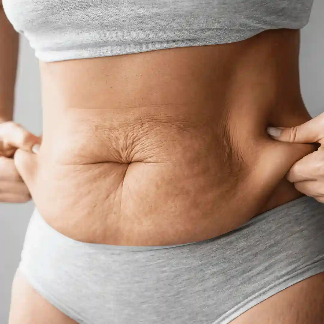 Is It Normal to Have Loose Skin After Pregnancy Witney?