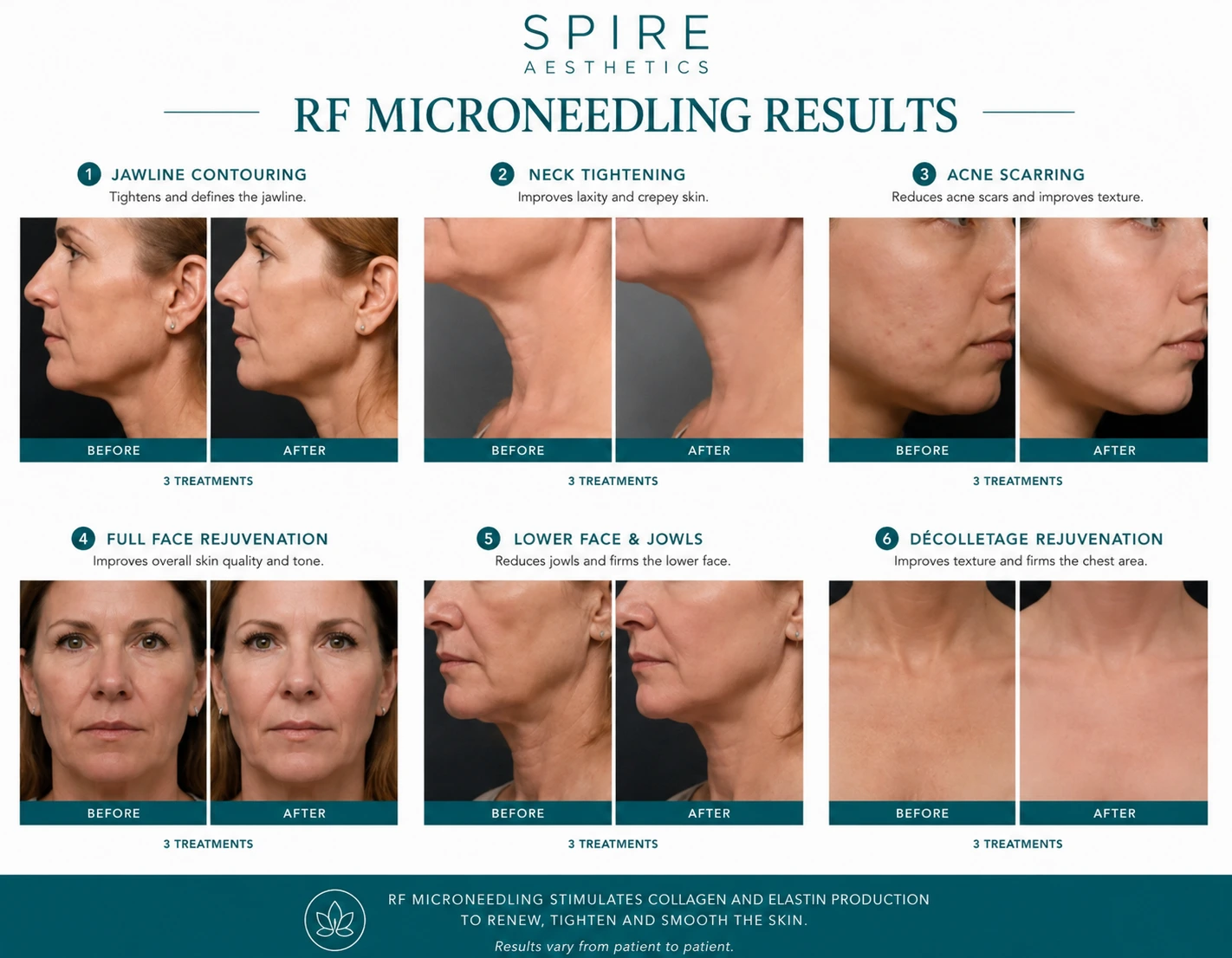 RF Microneedling Skin tightening Witney results