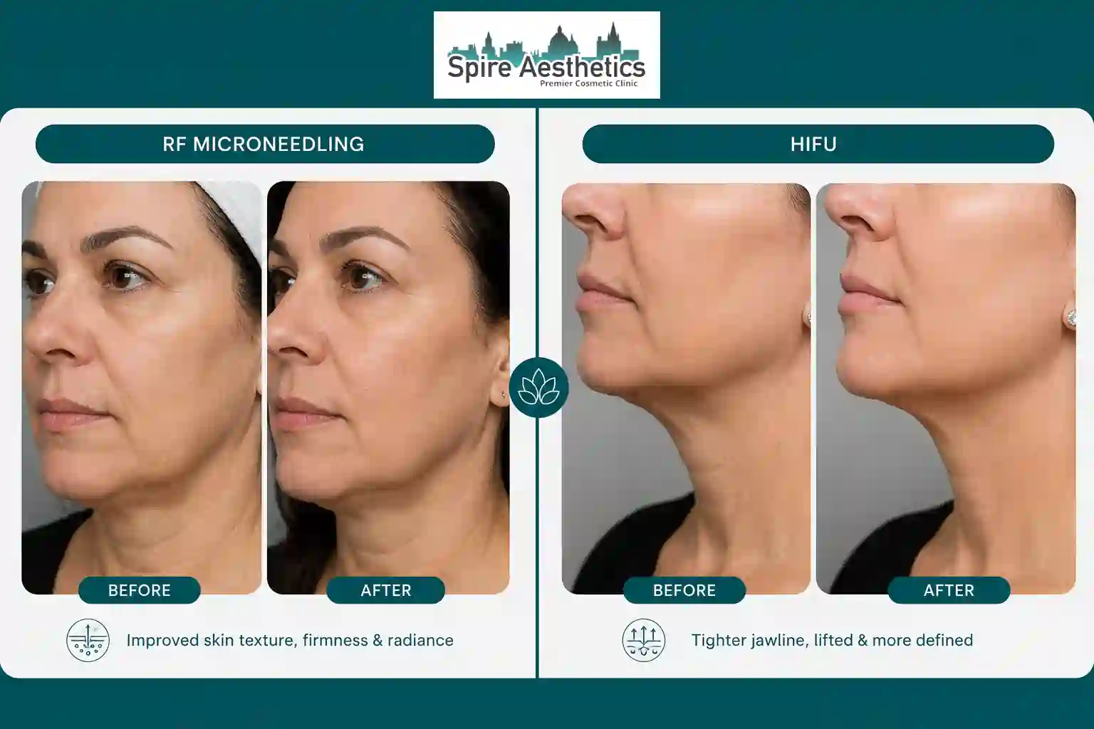 Can RF Microneedling and HIFU Be Combined Witney?