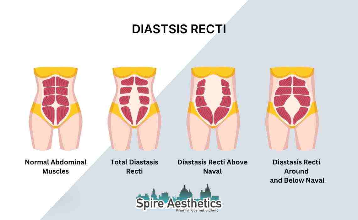 Is Non-Surgical Diastasis Recti Treatment Right for You? Common Concerns Answered Witney